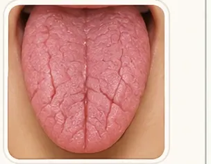 Lengua agrietada