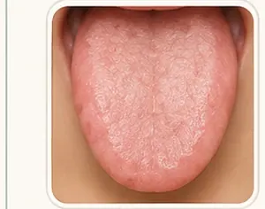 Lengua Rosa Normal