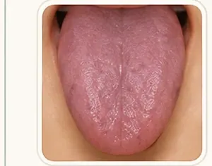 Lengua Púrpura