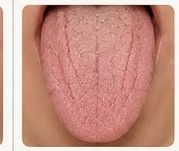 Lengua seca