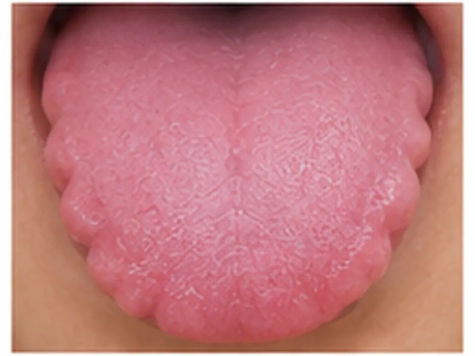 Lengua del paciente